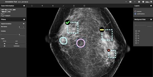 資策會利用近年來發展逐漸成熟的人工智能模型技術，應用於房病變偵測辨識解決方案，圖為人工智慧(AI)協助乳房X光攝影判讀影像。